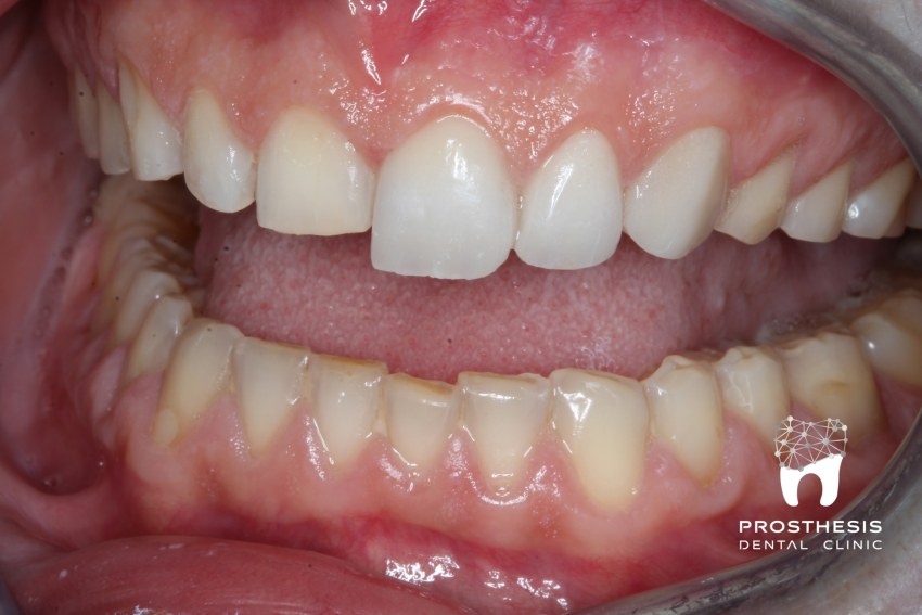 Περιστατικό 1 - Ενδοστοματική φωτογραφία πριν τη συγκόλληση των όψεων στα φυσικά δόντια της ασθενούς