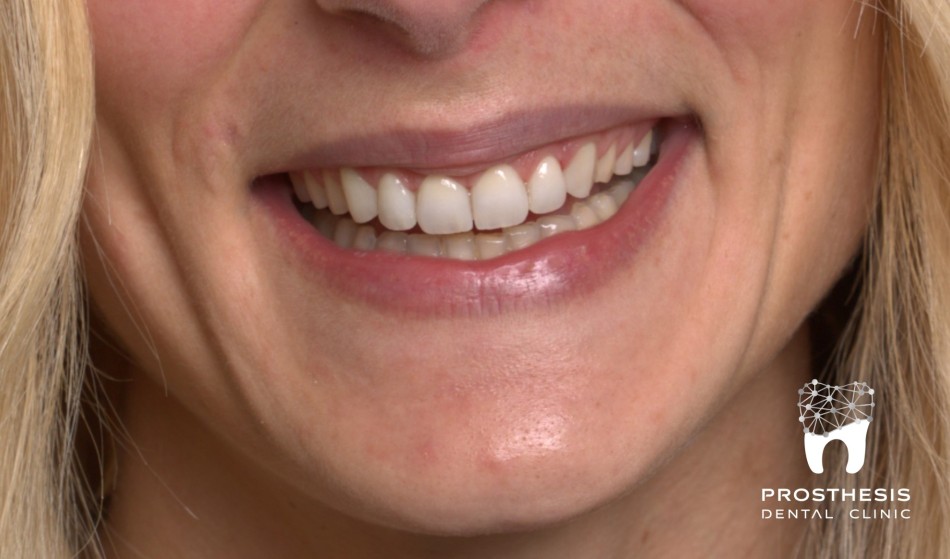 Περιστατικό 1 - Τελική Αποκατάσταση με ολοκεραμικές όψεις στα 6 άνω πρόσθια δόντια (#13-12-11-21-22-23)