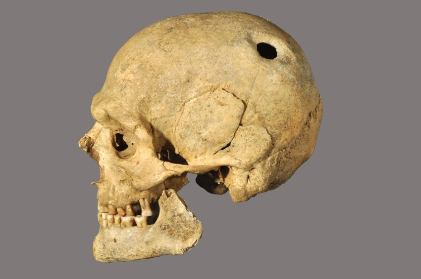 Κρανίο άνδρα με ίχνη χειρουργικής επέμβασης (τρυπανισμός). Β΄ μισό 2ου αι. π.Χ. Πόλη της Χίου (Ατσική - οικόπεδο Καραγιώργη)